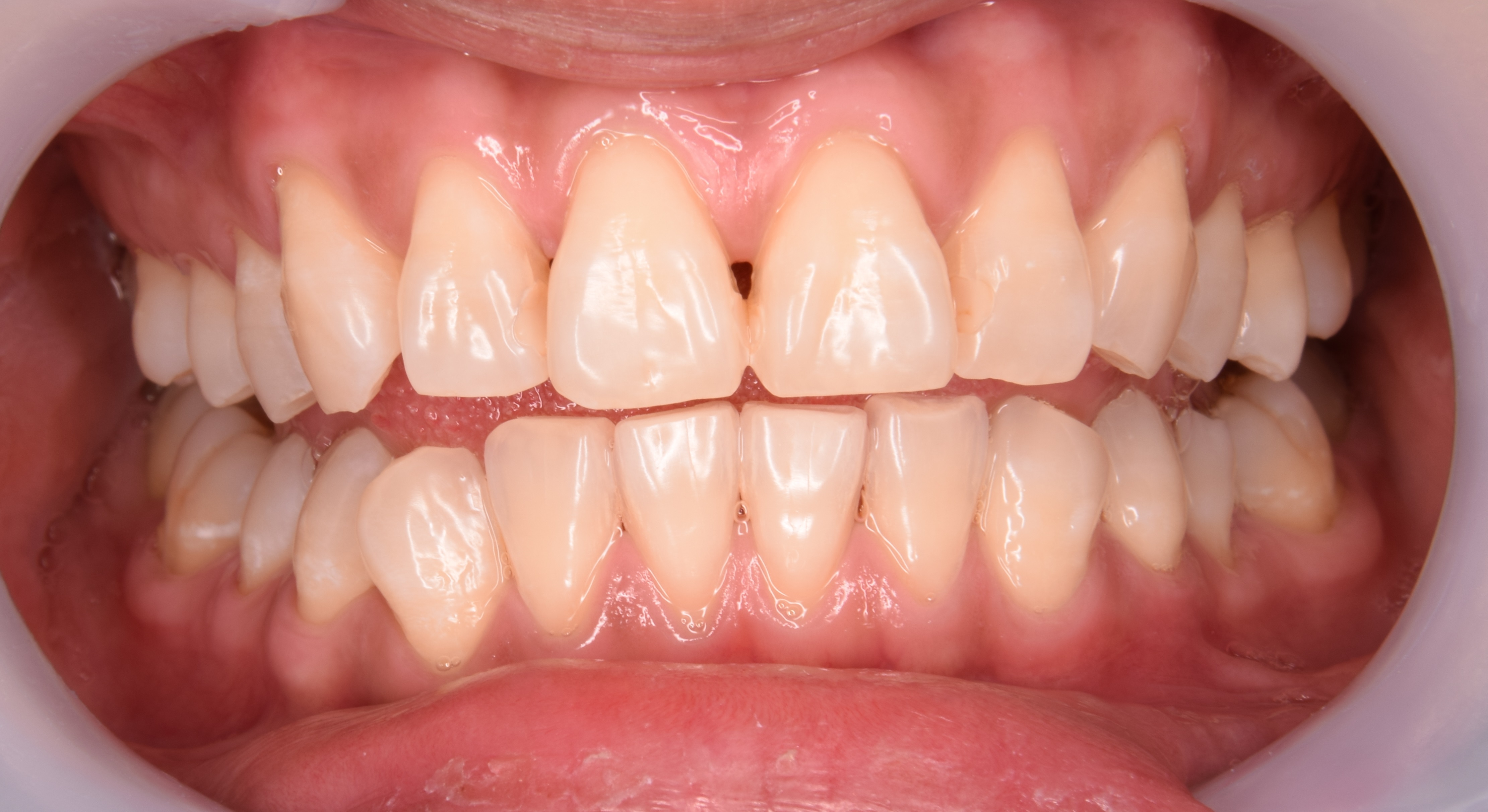 歯 と 歯茎 の 間 に 隙間